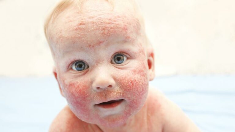 Sekilas Tentang Ruam pada Bayi Eczema