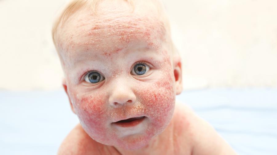 Sekilas Tentang Ruam pada Bayi Eczema